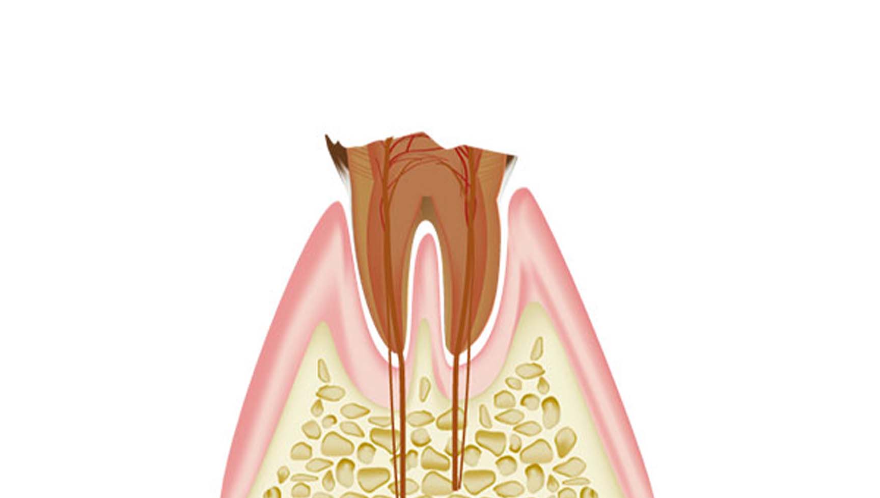 歯質が失われた虫歯