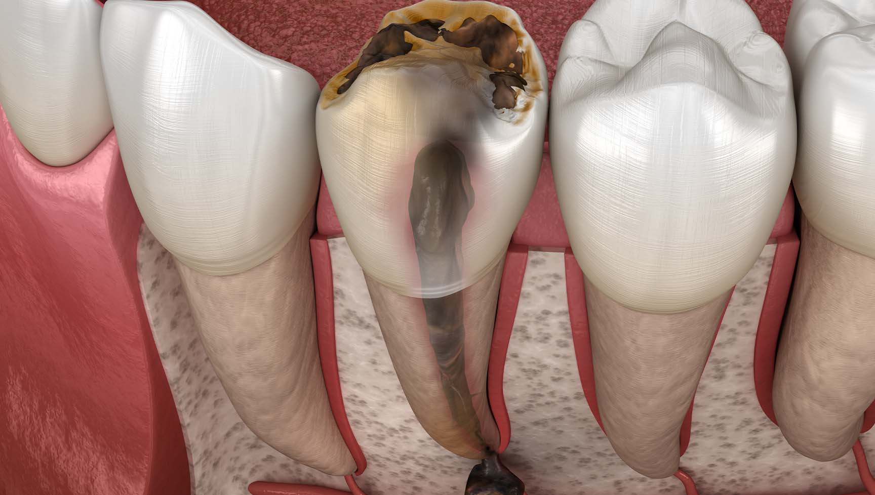 歯の根っこの先に膿が溜まってしまっている歯