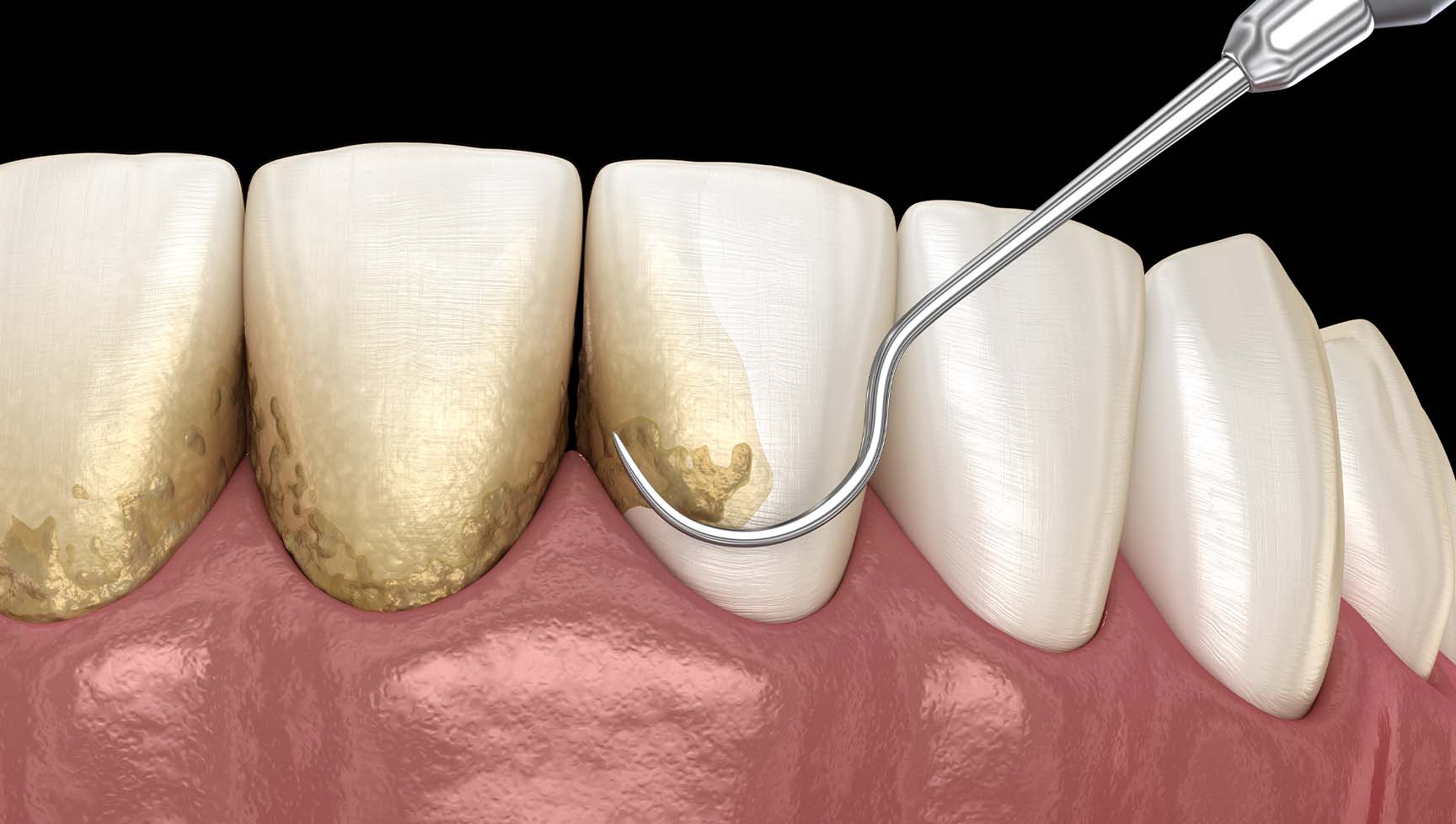歯と歯肉の間に溜まっていた歯石や歯垢(プラーク)除去